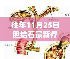 揭秘胆结石最新疗法，科技引领医疗革新，历年进展回顾（往年11月25日）