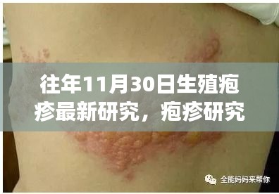 揭秘生殖疱疹新进展，疱疹研究新突破与往年最新研究成果发布