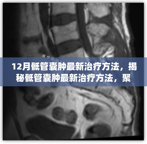 揭秘骶管囊肿最新治疗方法，聚焦十二月医学进展，为患者带来福音