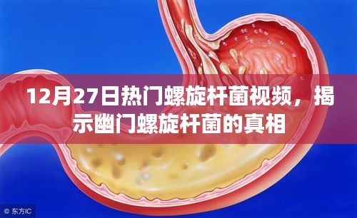 揭秘幽门螺旋杆菌真相，热门视频解析